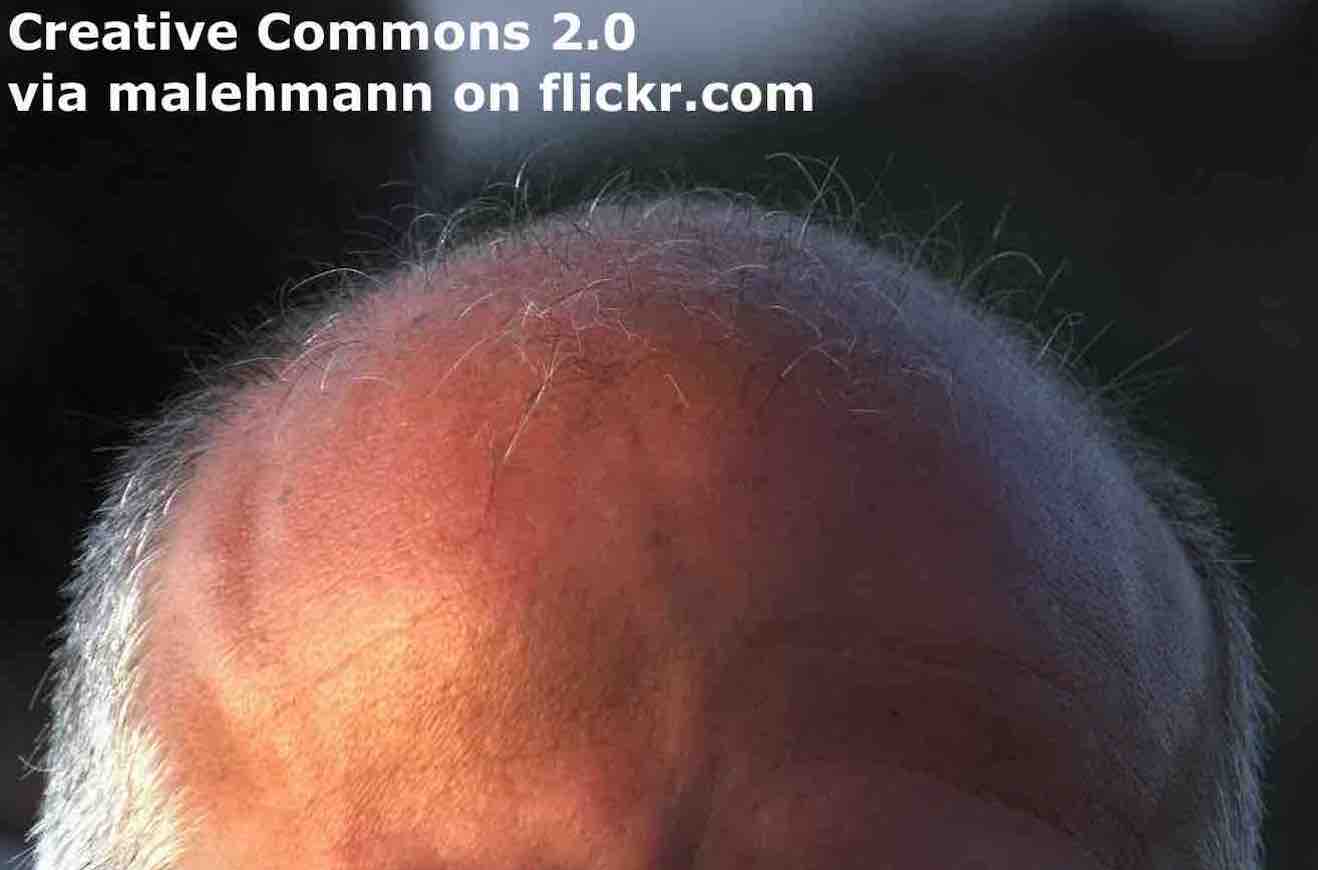 Breaking News English | Speed Reading - 100 wpm | Baldness