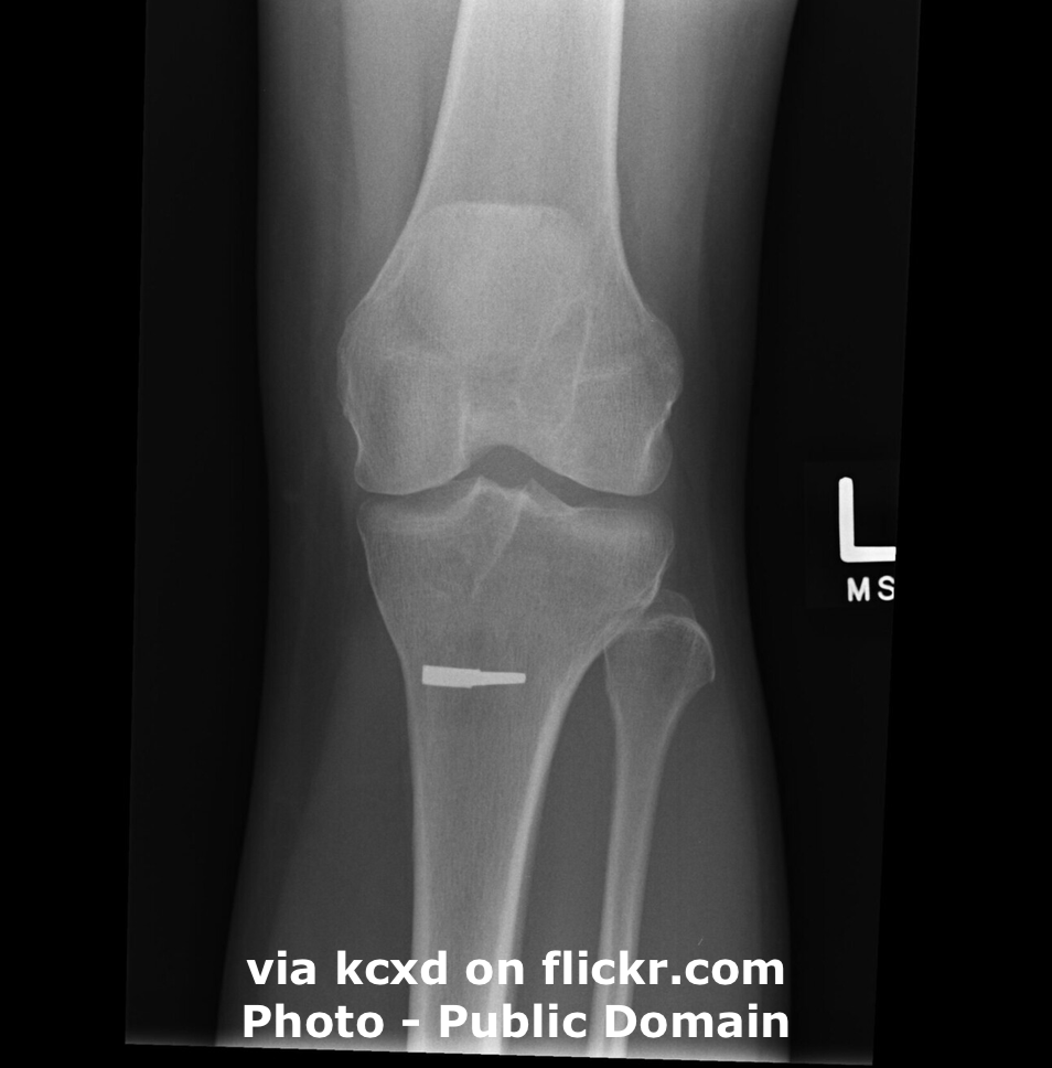 Lesson Plan In English Knee Surgery - ESL Lesson Plan - Breaking News English Lesson